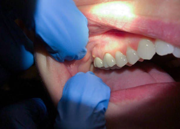 Best Emergency Treatment for Toothache in Topton, PA